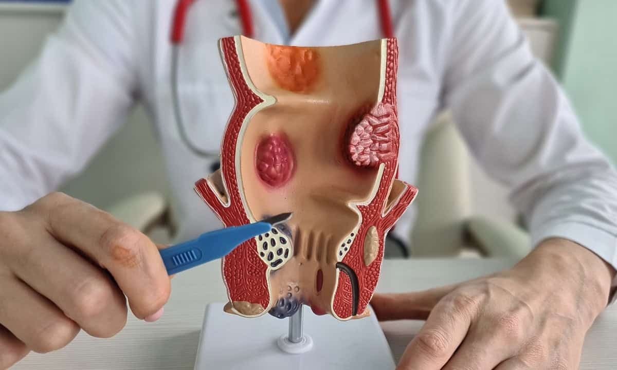Hemmorrhoids